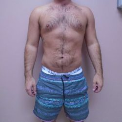Lipo 360 Before & After Patient #580