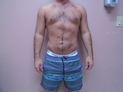 Lipo 360 Before & After Patient #580