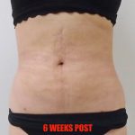 Lipo 360 Before & After Patient #538