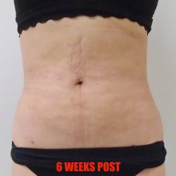 Lipo 360 Before & After Patient #538