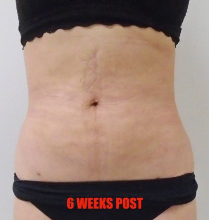 Lipo 360 Before & After Patient #538
