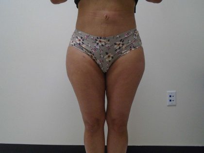 I-Thighs Before & After Patient #577