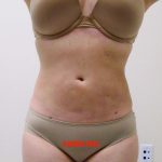 Lipo 360 Before & After Patient #544