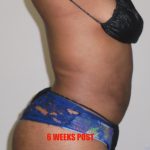 Lipo 360 Before & After Patient #547