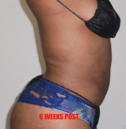 Lipo 360 Before & After Patient #547