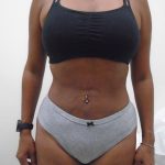 Lipo 360 Before & After Patient #550