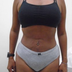 Lipo 360 Before & After Patient #550