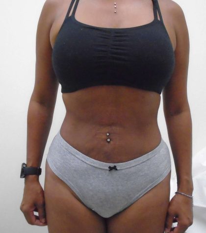 Lipo 360 Before & After Patient #550