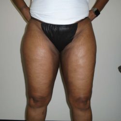 I-Thighs Before & After Patient #574