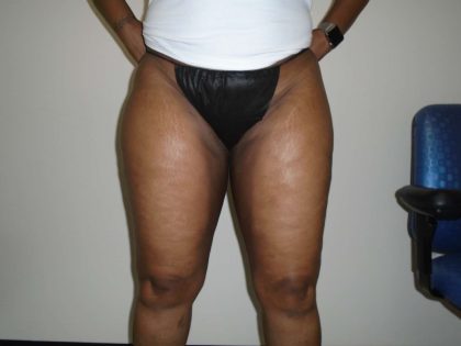 I-Thighs Before & After Patient #574