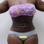 Lipo 360 Before & After Patient #553