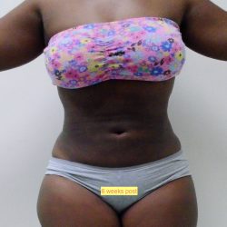 Lipo 360 Before & After Patient #553