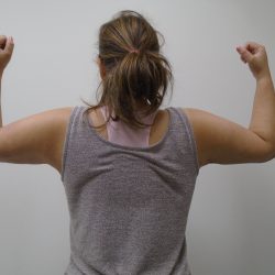 Arm Liposuction Before & After Patient #390