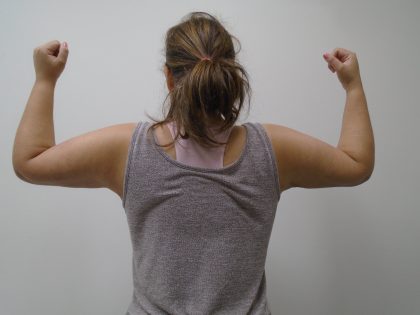 Arm Liposuction Before & After Patient #390