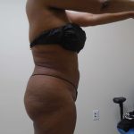 Lipo 360 Before & After Patient #482