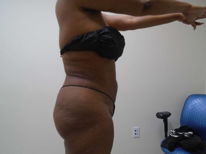 Lipo 360 Before & After Patient #482