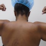 Arm Liposuction Before & After Patient #437