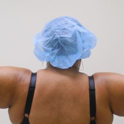 Arm Liposuction Before & After Patient #431
