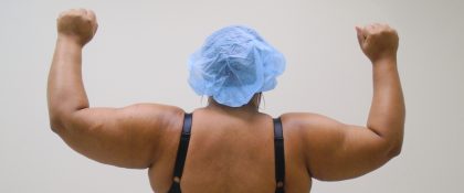 Arm Liposuction Before & After Patient #431