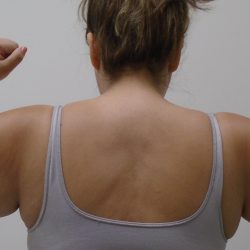 Arm Liposuction Before & After Patient #422