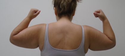 Arm Liposuction Before & After Patient #422