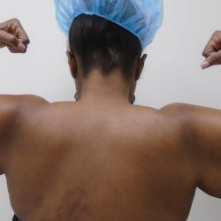 Arm Liposuction Before & After Patient #437