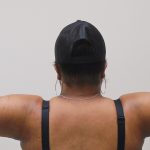 Arm Liposuction Before & After Patient #431