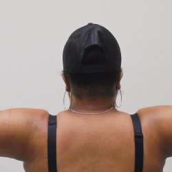 Arm Liposuction Before & After Patient #431