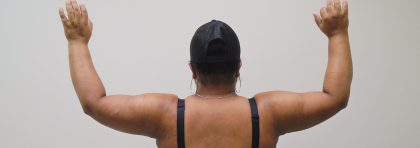 Arm Liposuction Before & After Patient #431