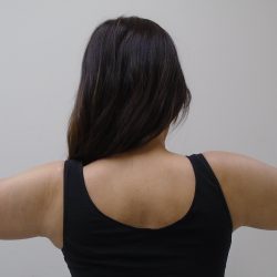 Arm Liposuction Before & After Patient #434