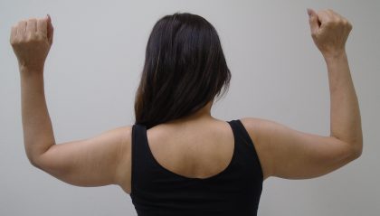 Arm Liposuction Before & After Patient #434