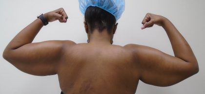 Arm Liposuction Before & After Patient #437