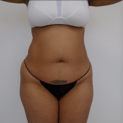 Lipo 360 Before & After Patient #495