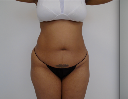 Lipo 360 Before & After Patient #495