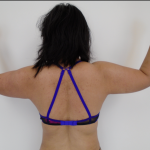 Arm Liposuction Before & After Patient #384