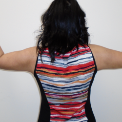 Arm Liposuction Before & After Patient #384