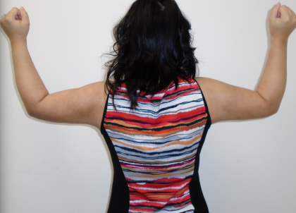 Arm Liposuction Before & After Patient #384