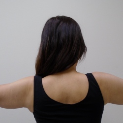 Arm Liposuction Before & After Patient #387
