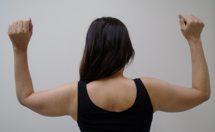 Arm Liposuction Before & After Patient #387