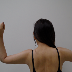 Arm Liposuction Before & After Patient #387