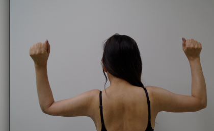 Arm Liposuction Before & After Patient #387