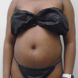 Lipo 360 Before & After Patient #520