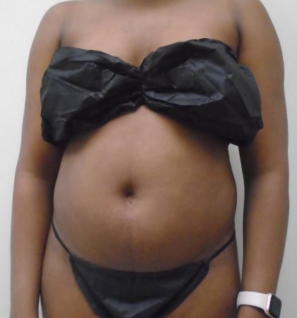 Lipo 360 Before & After Patient #520
