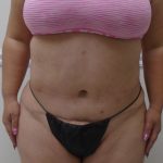 Lipo 360 Before & After Patient #568