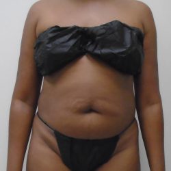 Lipo 360 Before & After Patient #529