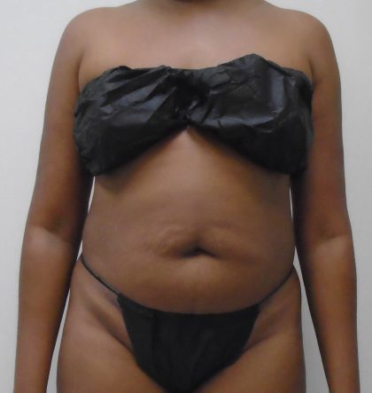 Lipo 360 Before & After Patient #529