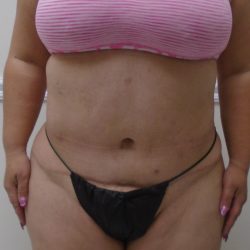 Lipo 360 Before & After Patient #568
