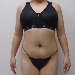 Lipo 360 Before & After Patient #556