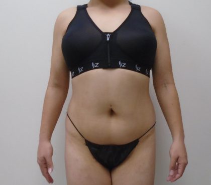 Lipo 360 Before & After Patient #556
