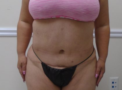 Lipo 360 Before & After Patient #568